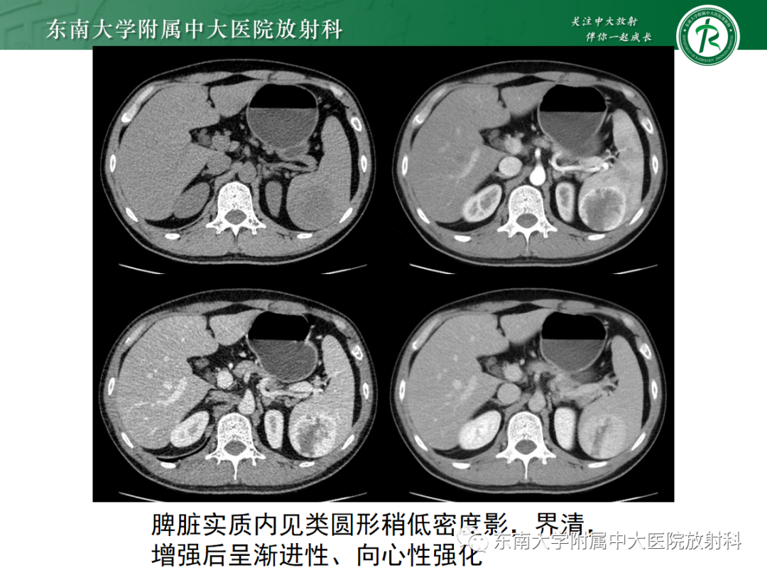 【PPT】脾脏硬化性血管瘤样结节性转化-15
