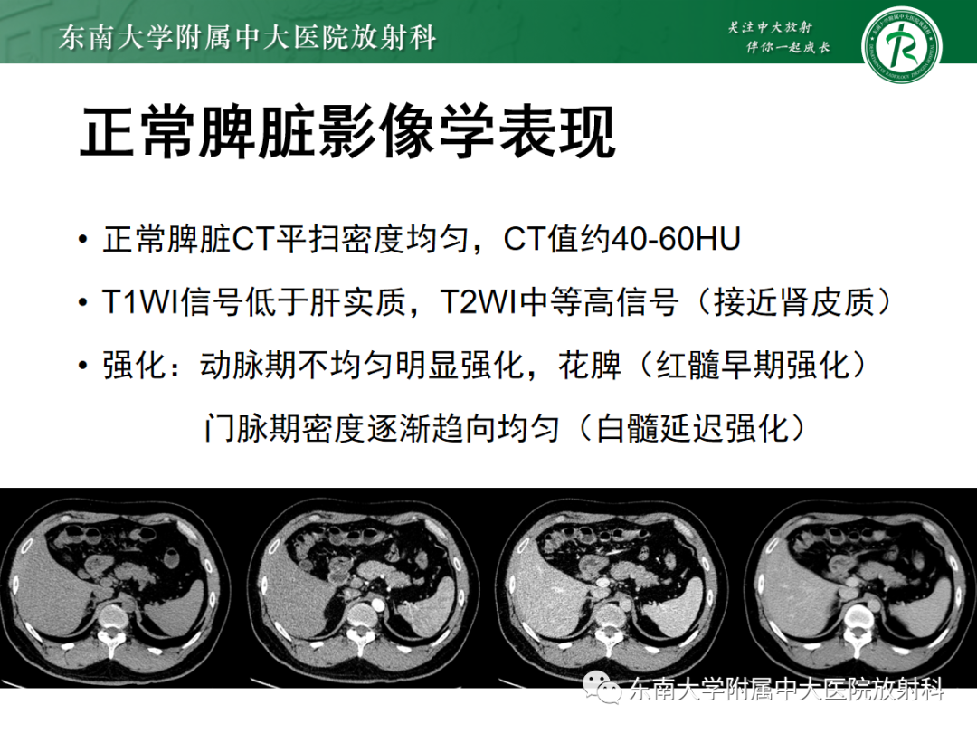 【PPT】脾脏硬化性血管瘤样结节性转化-5