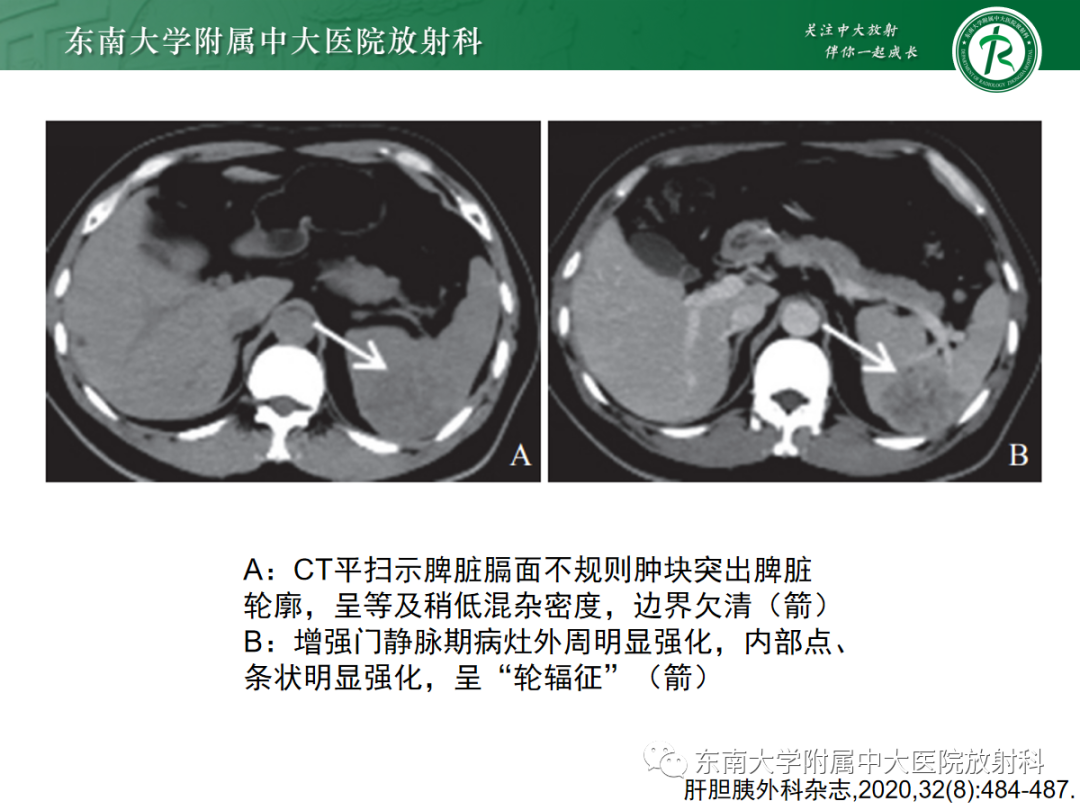 【PPT】脾脏硬化性血管瘤样结节性转化-9
