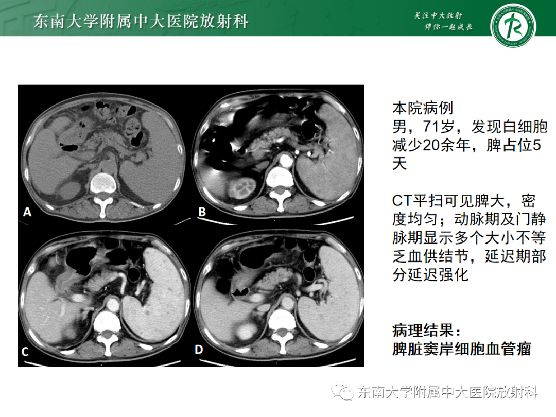 【PPT】脾脏硬化性血管瘤样结节性转化-23