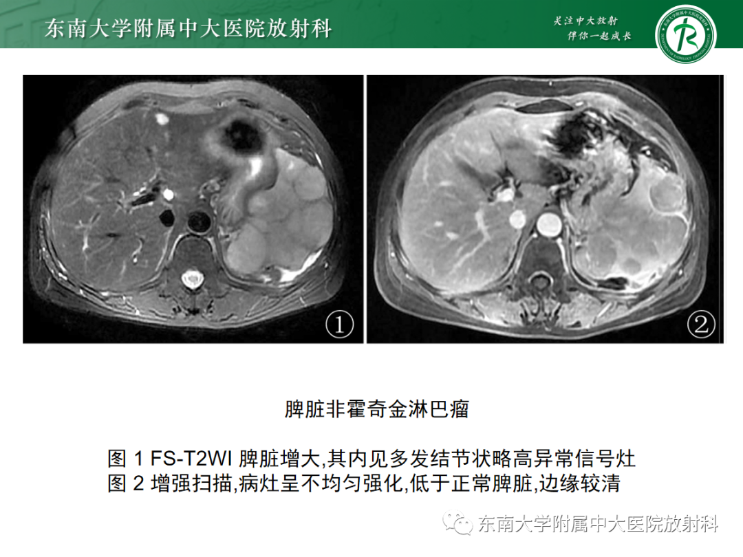 【PPT】脾脏硬化性血管瘤样结节性转化-33