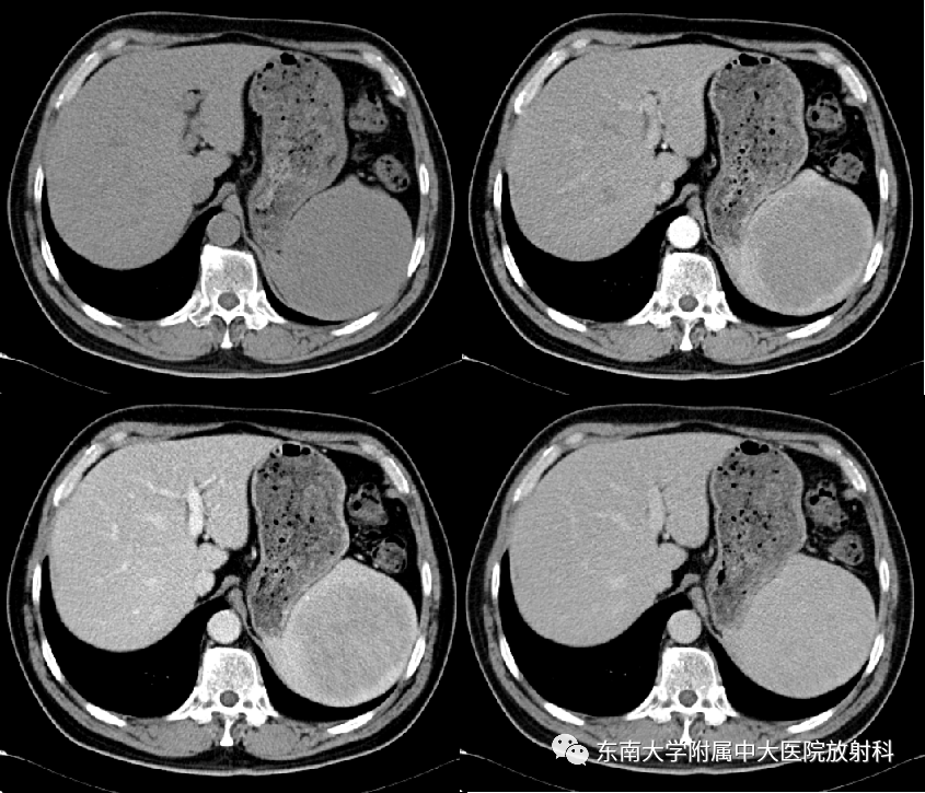 【PPT】脾脏硬化性血管瘤样结节性转化-2