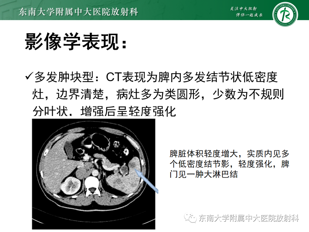【PPT】脾脏硬化性血管瘤样结节性转化-30