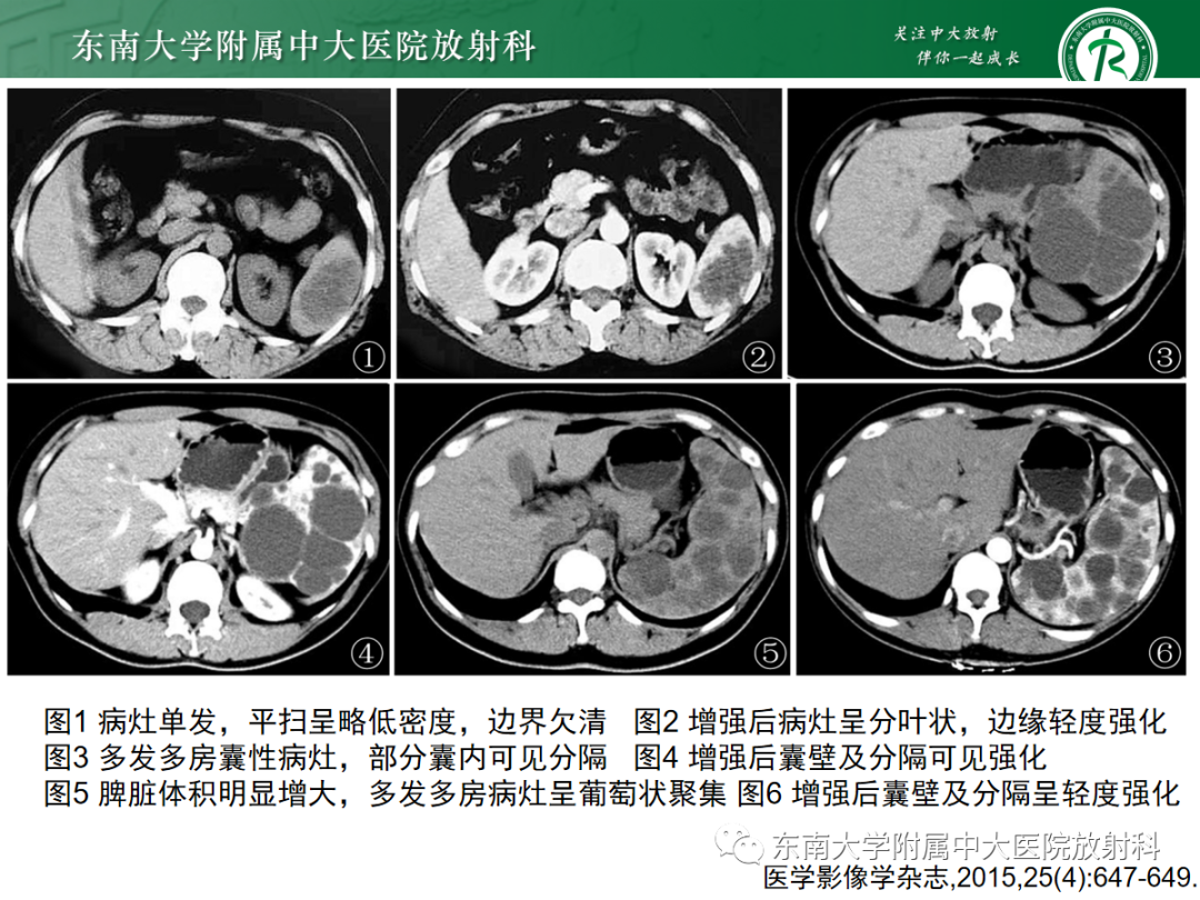 【PPT】脾脏硬化性血管瘤样结节性转化-18