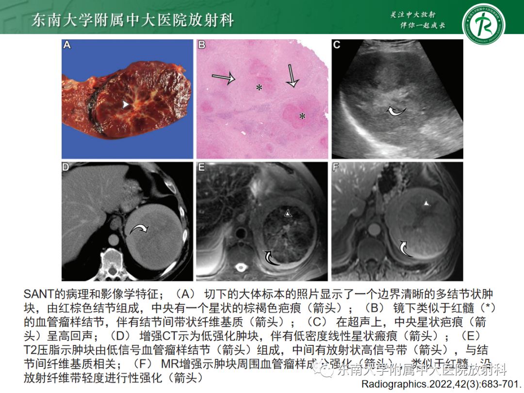 【PPT】脾脏硬化性血管瘤样结节性转化-11