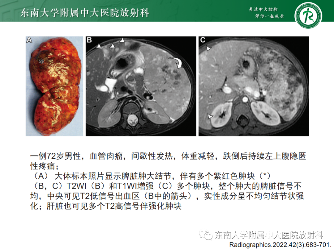 【PPT】脾脏硬化性血管瘤样结节性转化-27