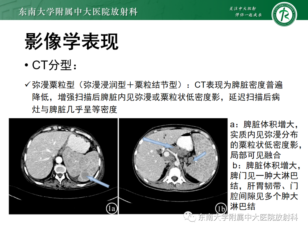 【PPT】脾脏硬化性血管瘤样结节性转化-29