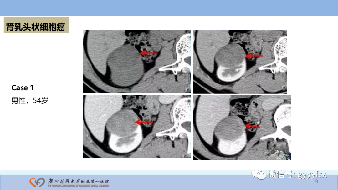 【PPT】肾癌相关影像诊断的文献汇报-9