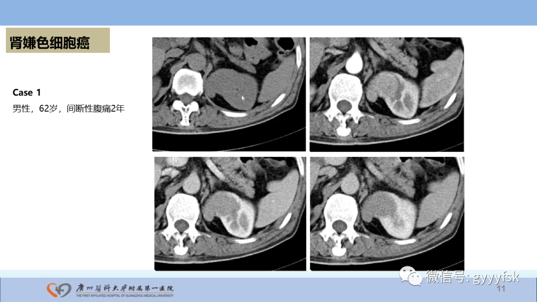 【PPT】肾癌相关影像诊断的文献汇报-11