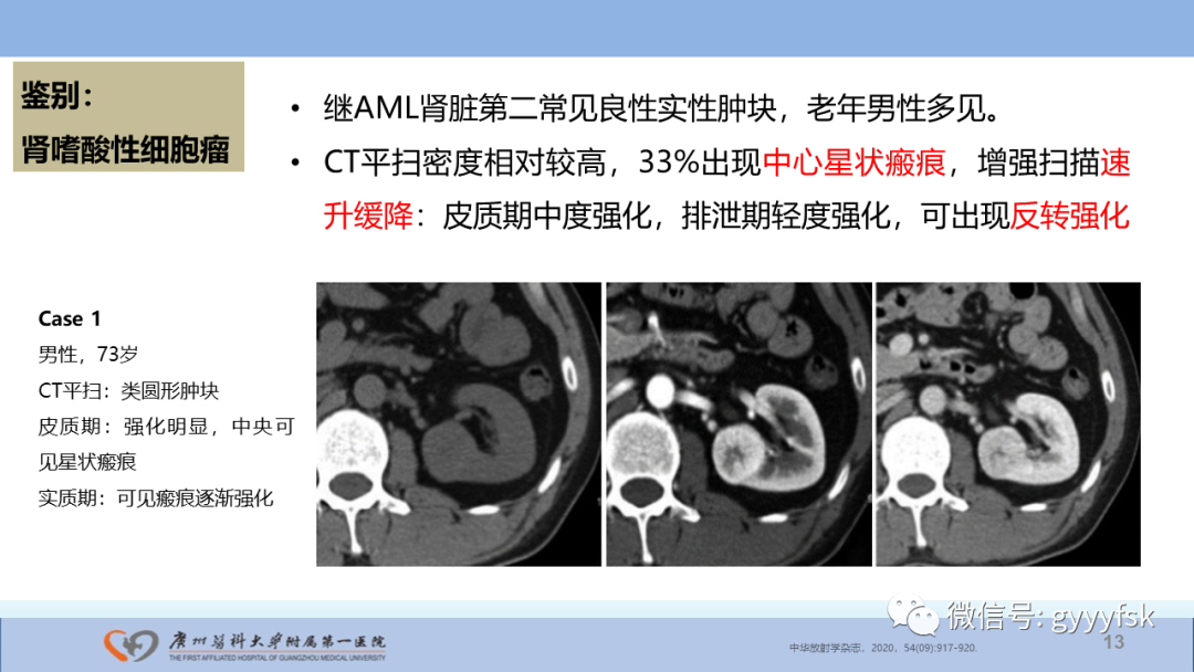 【PPT】肾癌相关影像诊断的文献汇报-13