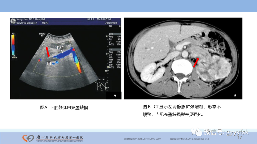 【PPT】肾癌相关影像诊断的文献汇报-17