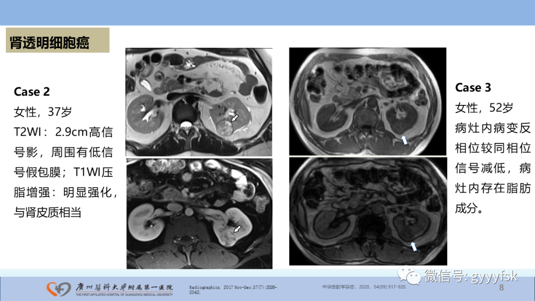 【PPT】肾癌相关影像诊断的文献汇报-8