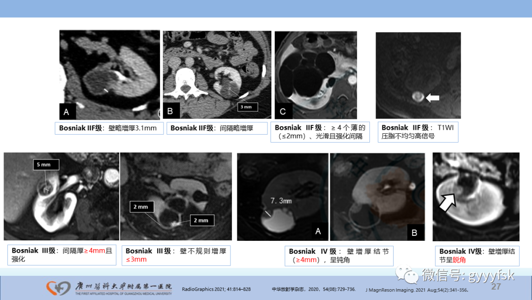 【PPT】肾癌相关影像诊断的文献汇报-27