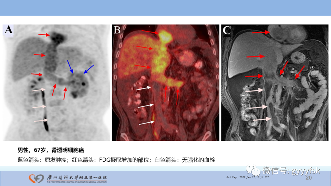 【PPT】肾癌相关影像诊断的文献汇报-20