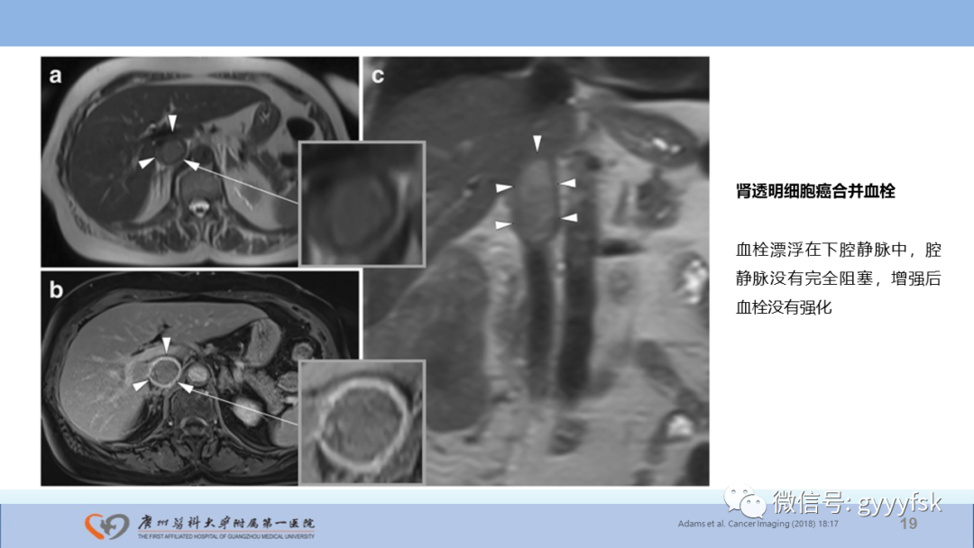 【PPT】肾癌相关影像诊断的文献汇报-19