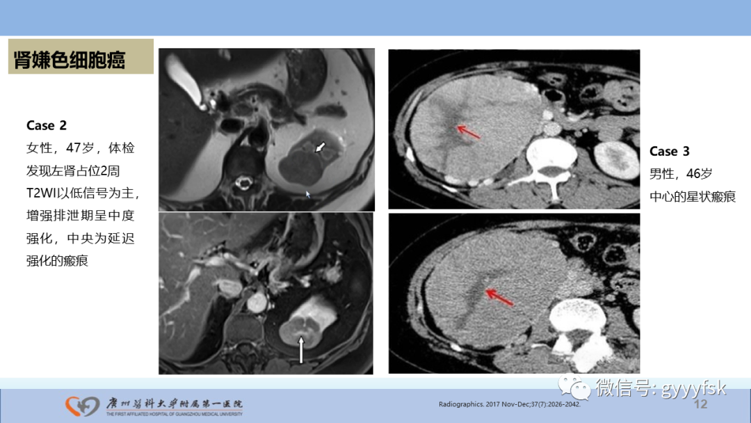 【PPT】肾癌相关影像诊断的文献汇报-12