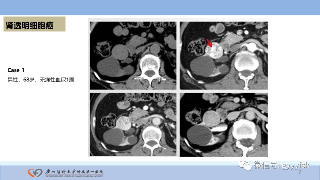【PPT】肾癌相关影像诊断的文献汇报-7