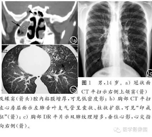 【病例】当支气管扩张遇上右位心 ——Kartagener综合征