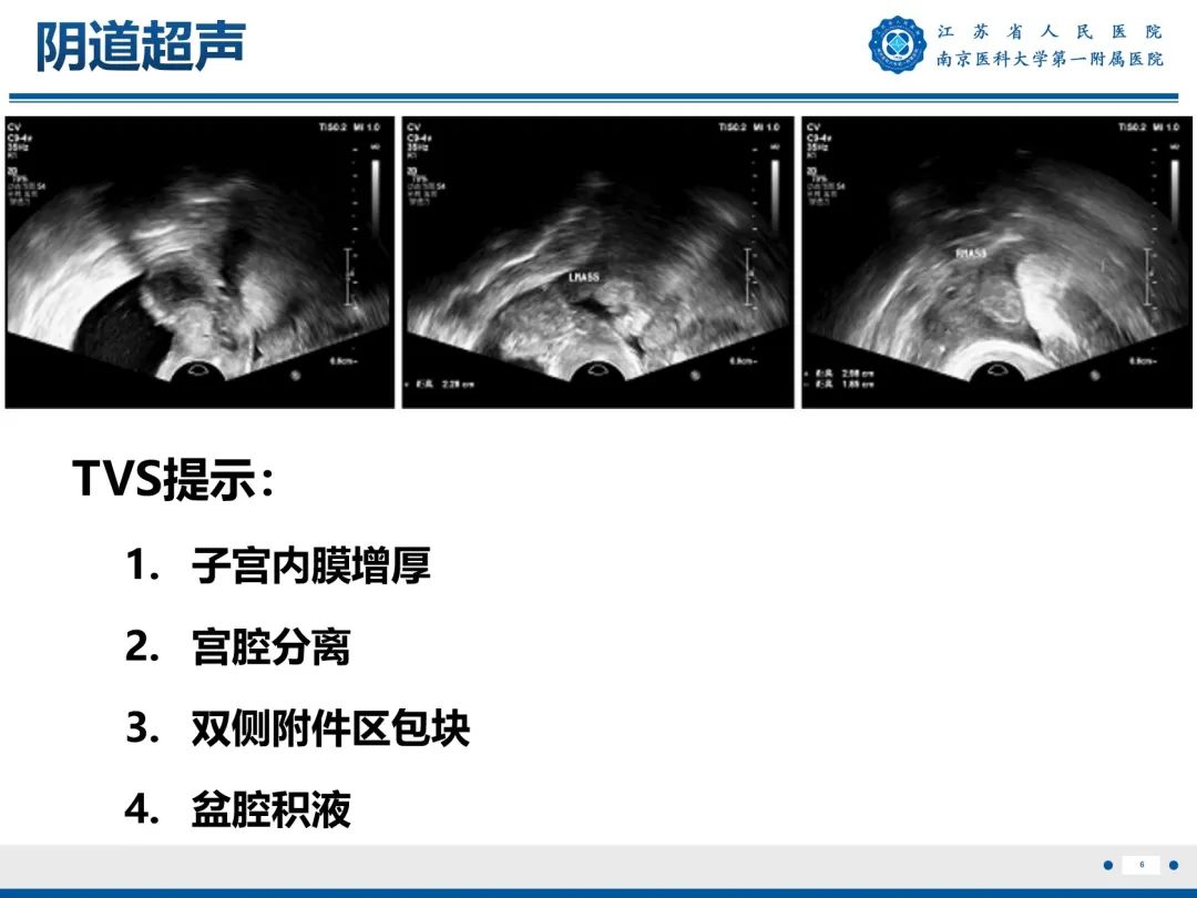 【PPT】输卵管结核-7