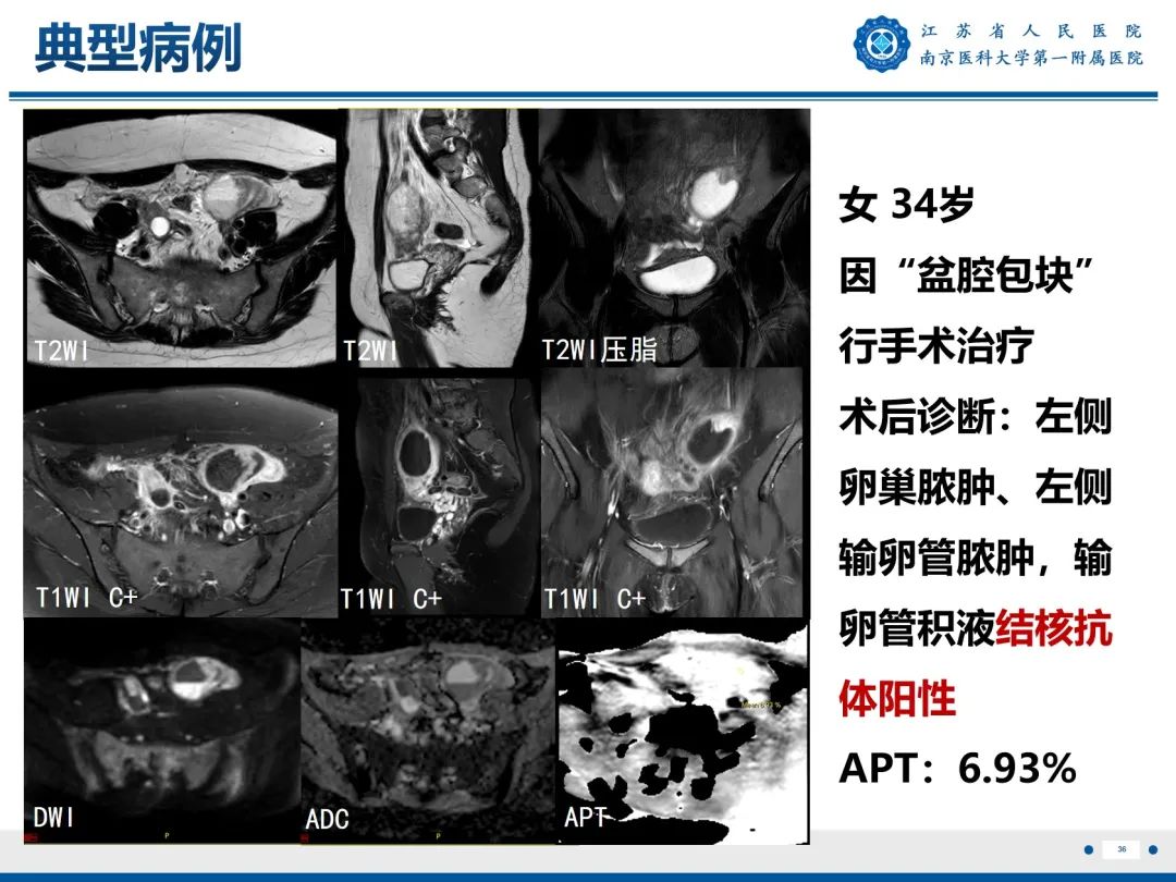【PPT】输卵管结核-37