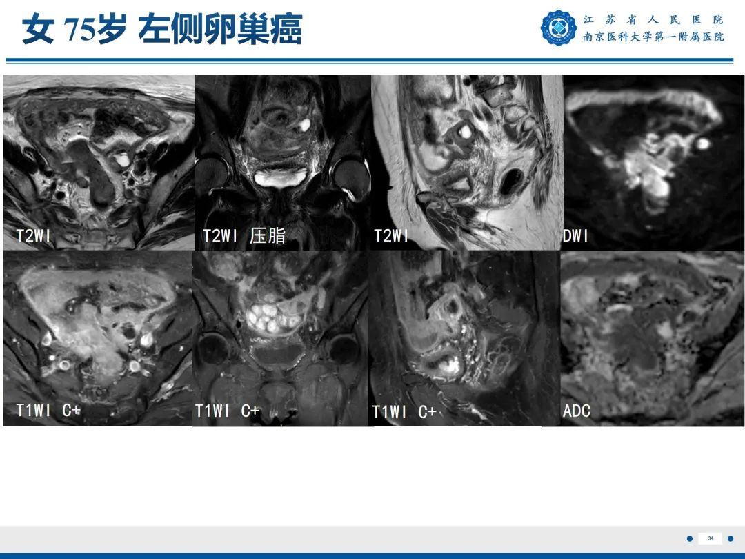 【PPT】输卵管结核-35