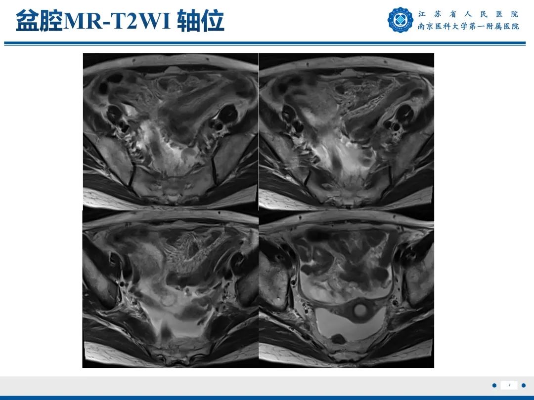 【PPT】输卵管结核-8