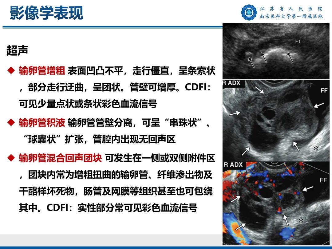 【PPT】输卵管结核-25