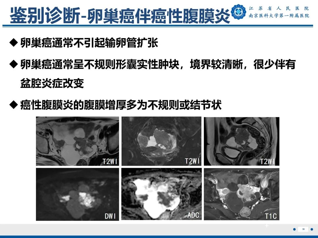 【PPT】输卵管结核-39