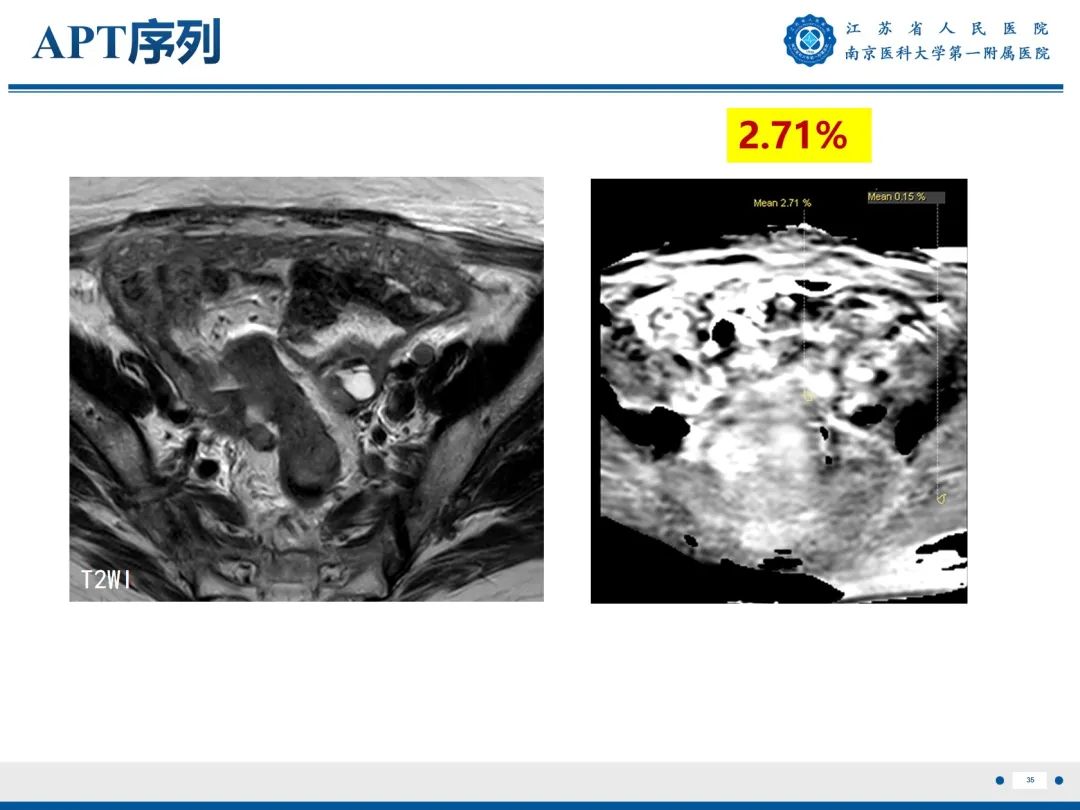 【PPT】输卵管结核-36