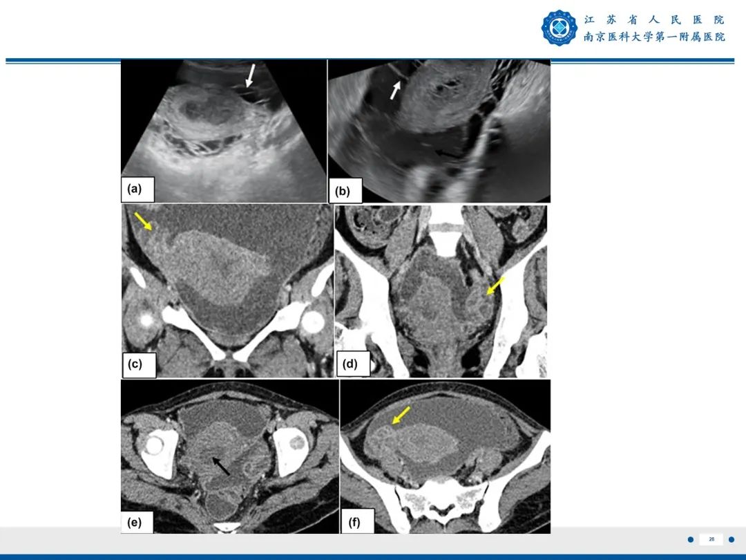 【PPT】输卵管结核-29