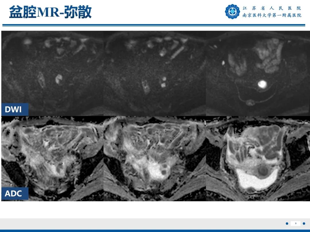 【PPT】输卵管结核-10