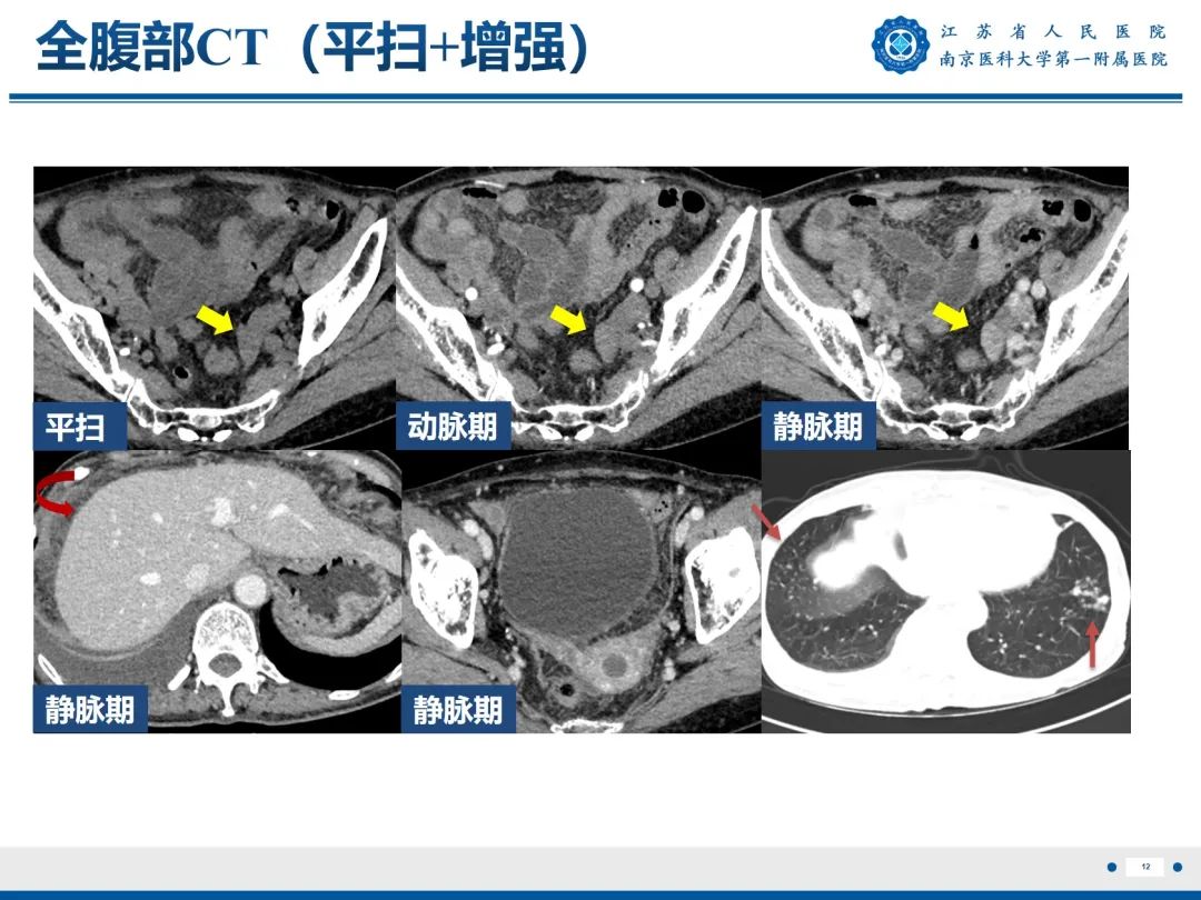 【PPT】输卵管结核-13