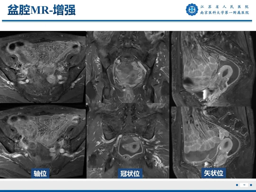 【PPT】输卵管结核-11