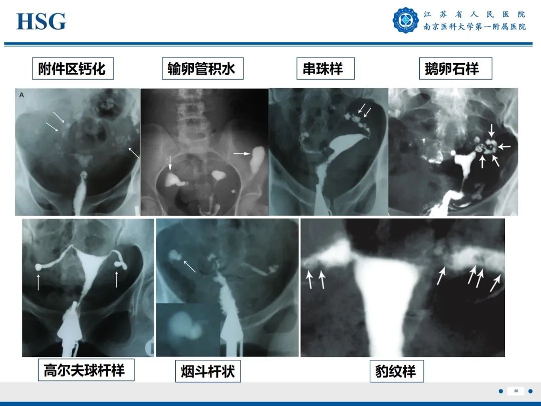 【PPT】输卵管结核-27