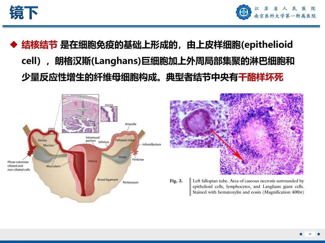 【PPT】输卵管结核-21