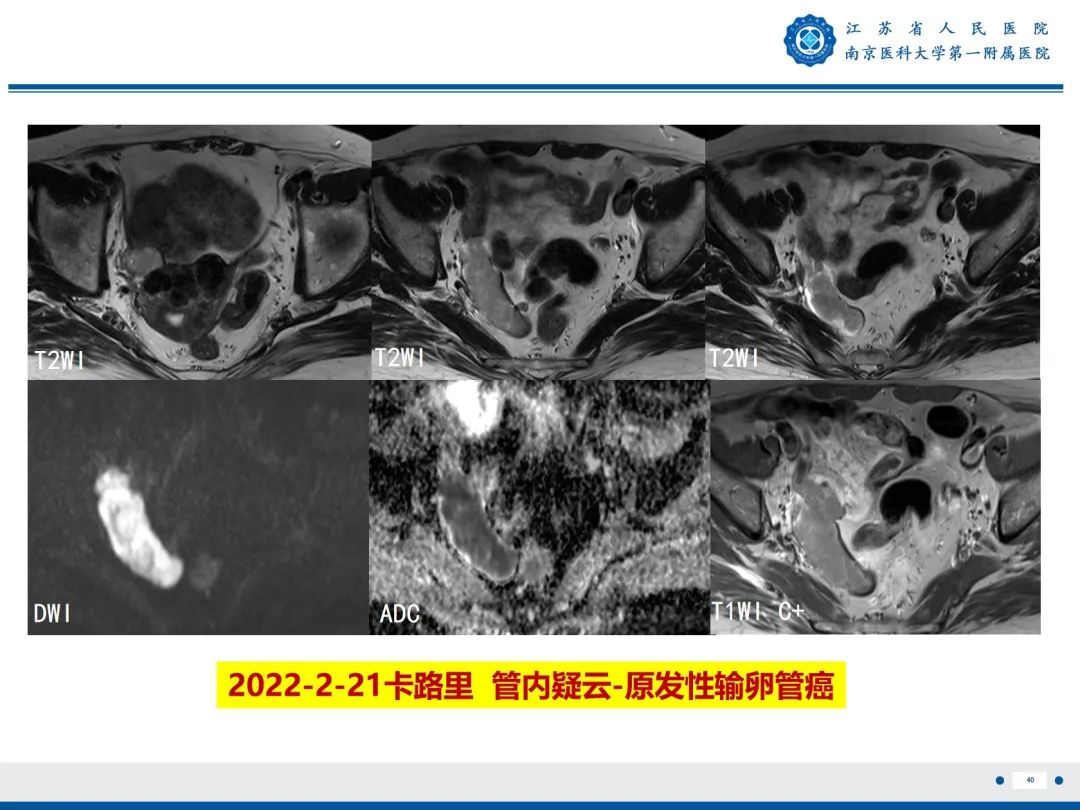 【PPT】输卵管结核-41