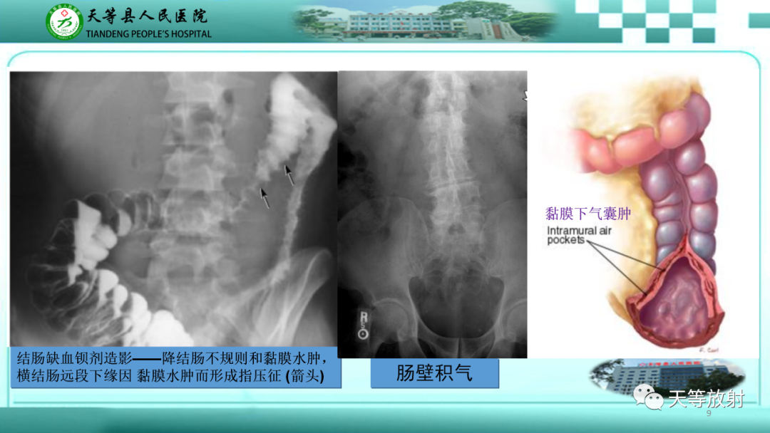 【PPT】缺血性肠病的影像学表现-8