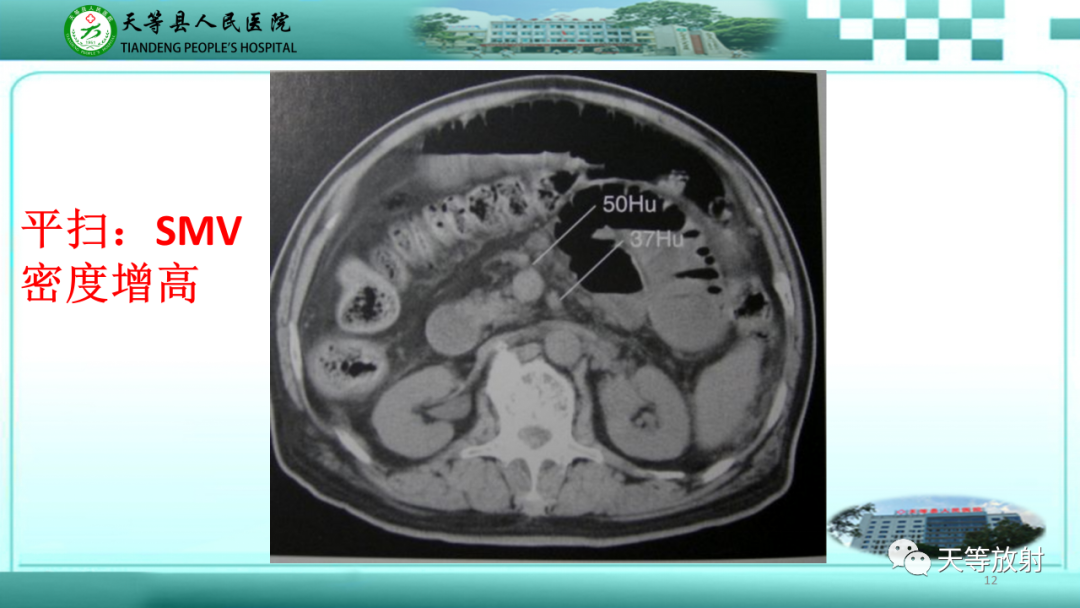 【PPT】缺血性肠病的影像学表现-11