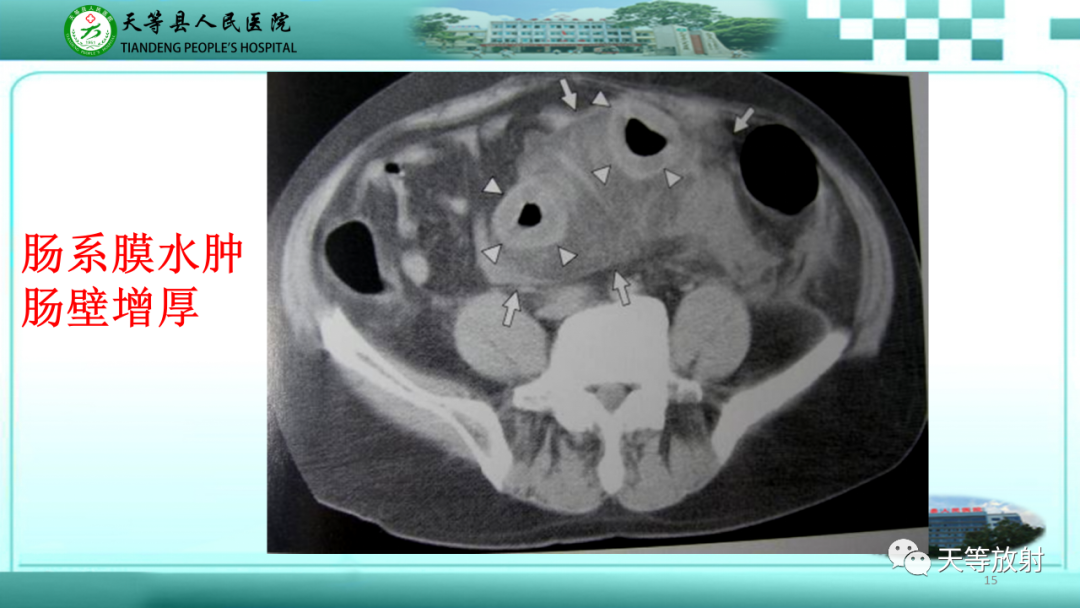 【PPT】缺血性肠病的影像学表现-14