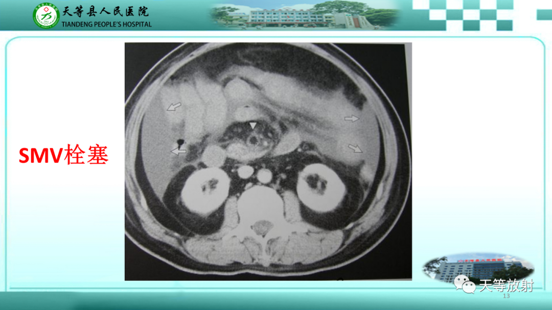 【PPT】缺血性肠病的影像学表现-12