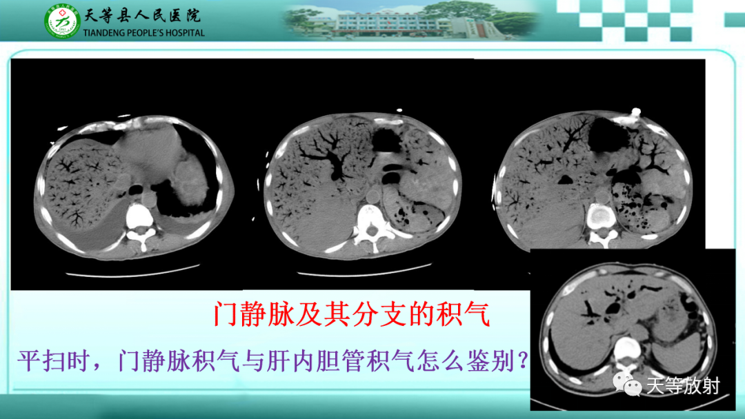 【PPT】缺血性肠病的影像学表现-16