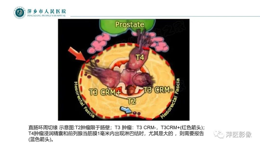 【PPT】直肠癌MR分期-18