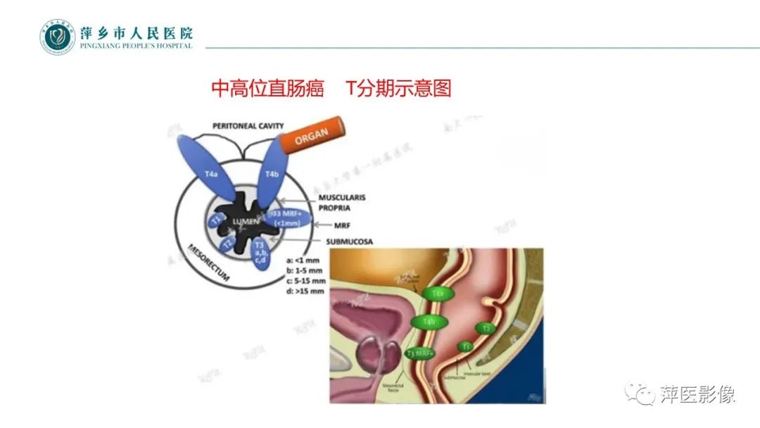 【PPT】直肠癌MR分期-31