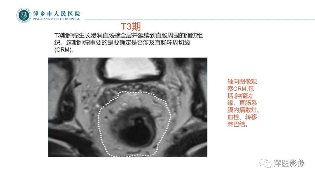 【PPT】直肠癌MR分期-33