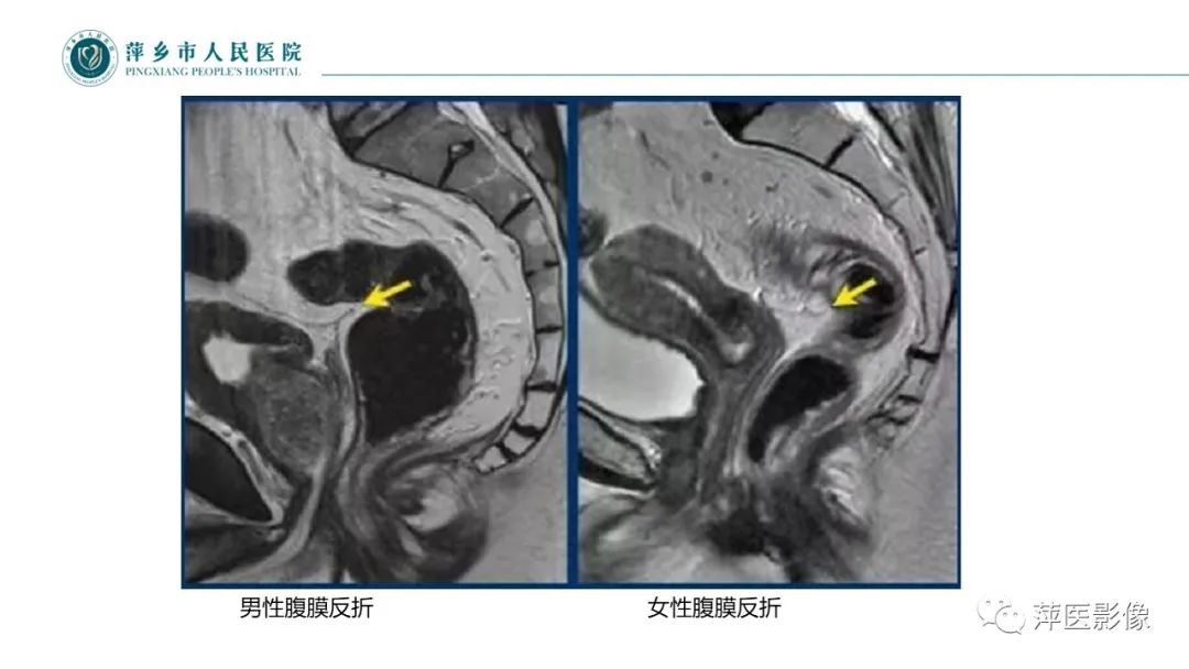 【PPT】直肠癌MR分期-24