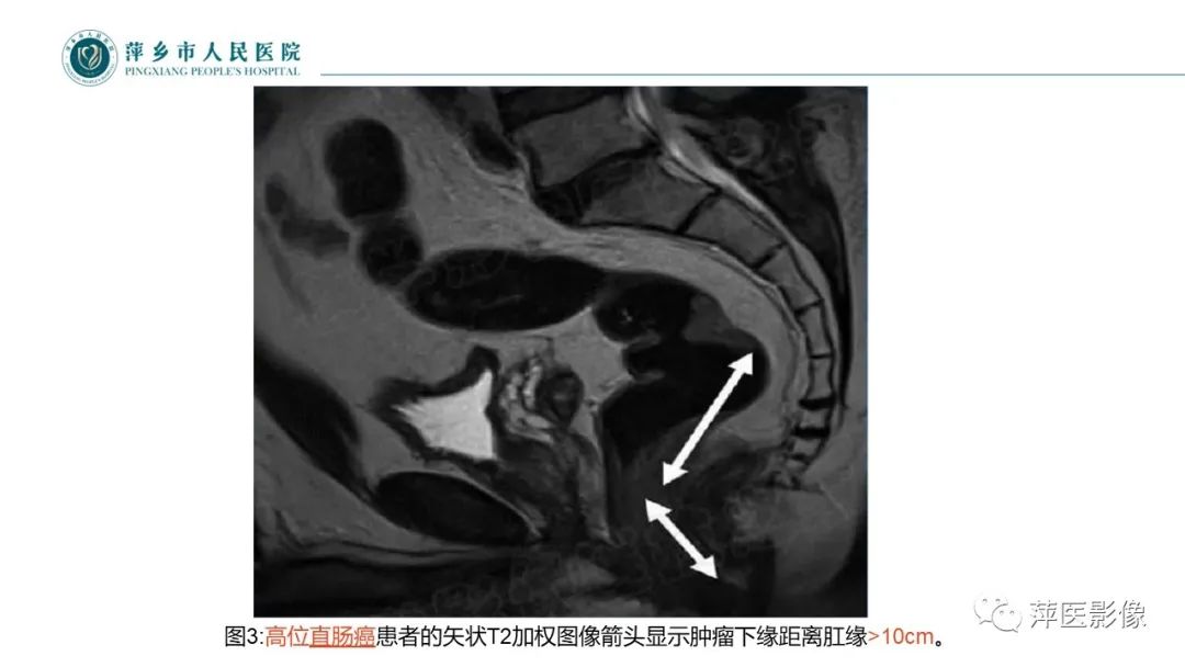 【PPT】直肠癌MR分期-29