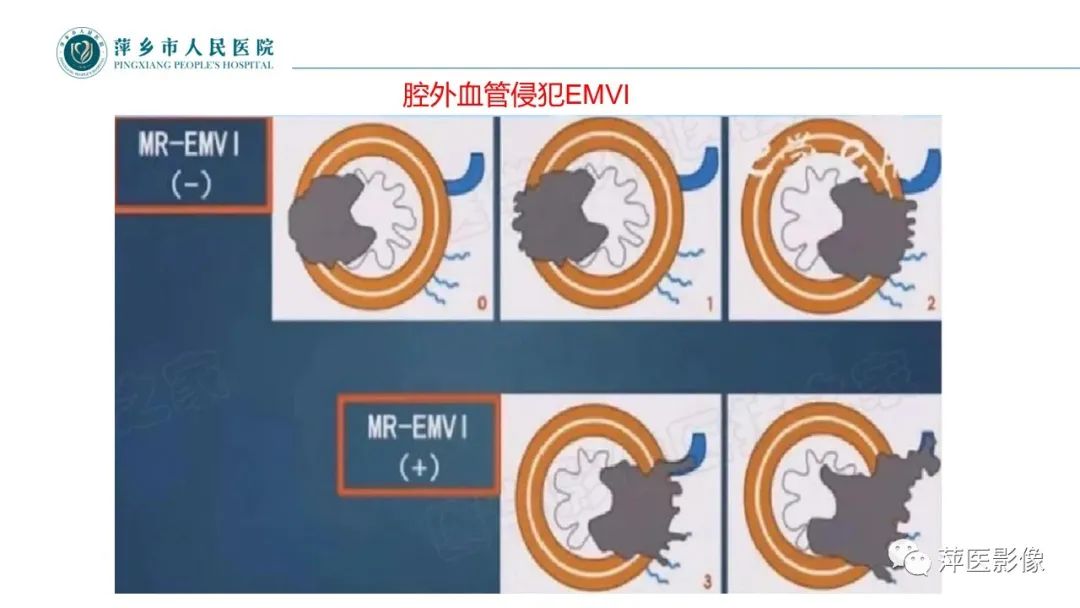 【PPT】直肠癌MR分期-21