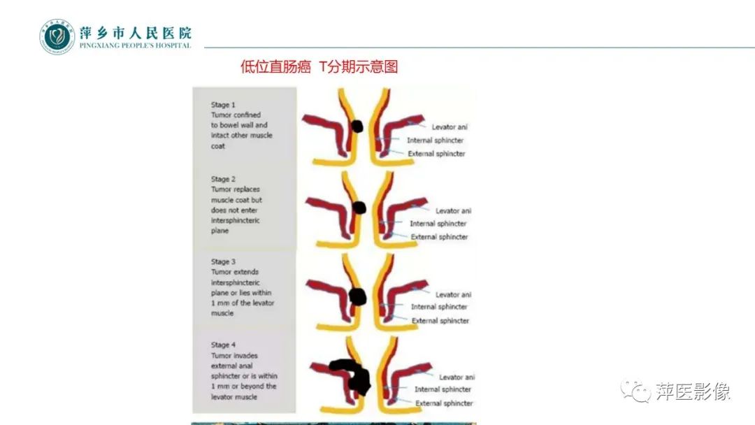 【PPT】直肠癌MR分期-39