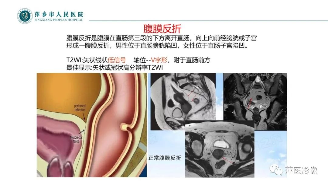 【PPT】直肠癌MR分期-23