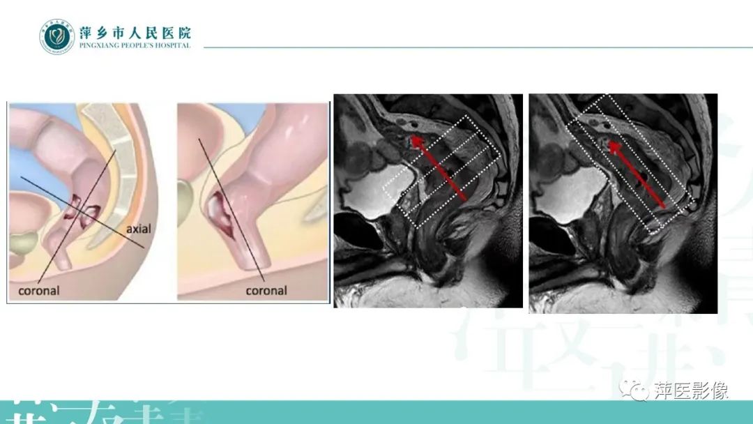 【PPT】直肠癌MR分期-9